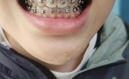 儿童牙齿地包天正畸，何时开始矫正最合适？