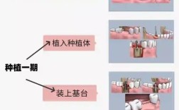 种植种牙是什么原因