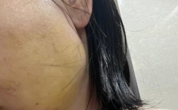 种完牙下巴青了