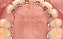 正畸舌挡是活动的吗