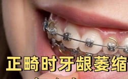 矫正牙齿牙龈萎缩