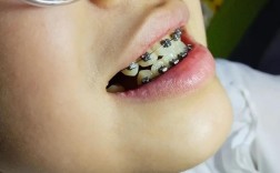 矫正牙齿后怀孕了