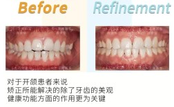 咬合不正正畸方法