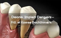 牙种植的危害科瓦标杆