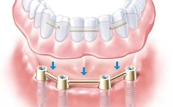 深圳哪里可以做种植牙？正规机构如何挑选？