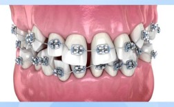 卡瓦数字化传统正畸