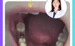 种半口牙需要住院吗？术后恢复要注意什么？