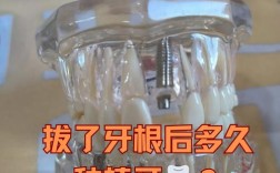 拔完牙后究竟要等多久才能种牙？不同愈合阶段的时间差异和影响种植时机的关键因素有哪些？