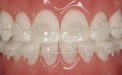 陶瓷托槽摘取法如何安全高效操作？关键步骤与注意事项是什么？