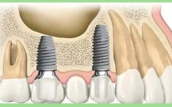数字化导航种牙，精准高效有何优势？