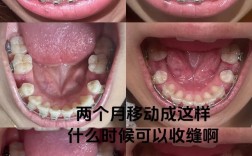 正畸治疗时牙龈会跟着牙齿移动吗？其移动机制、对口腔健康的影响及日常护理注意事项有哪些？