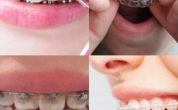 矫正牙齿后人中变长，是正常现象吗？