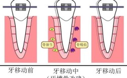 牙齿矫正原理图