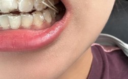 隐形矫正时智齿必须拔除吗？