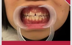 扩牙器如何正确使用？详细步骤与注意事项有哪些？