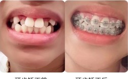 牙齿不齐矫正疼吗？正畸过程会有多痛苦？