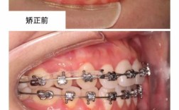 多学科联合如何破解成人正畸复杂难题？