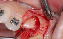 尖牙埋伏阻生正畸牵引如何有效牵引？