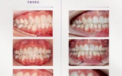 不拔牙矫正可行吗？效果会打折扣吗？