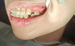 牙齿正畸打骨钉图片，过程疼不疼？效果怎么样？