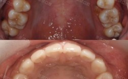 正畸发现埋伏牙，会影响矫正效果吗？