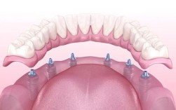 北京口腔医院 3d植牙