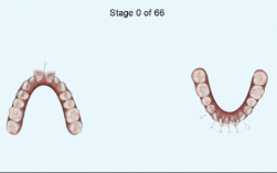 正畸过程动态图