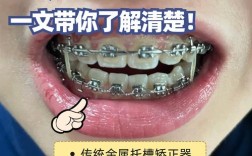 上海牙套矫正贵吗？费用大概多少？