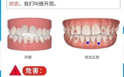 牙齿开颌能矫正吗？