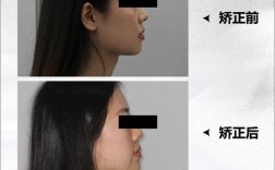 自己怎么矫正牙齿龅牙