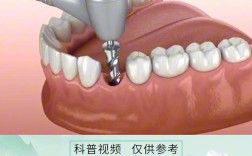 种牙安装过程视频，具体步骤是怎么操作的？