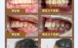 隐形正畸对脸型改变