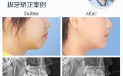 成人牙齿矫正为何要拔牙？