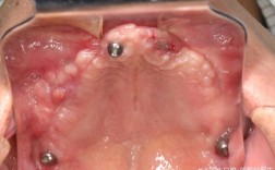 上额窦漏能种牙吗？风险与条件需知