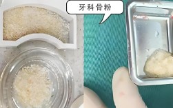 牙槽骨薄 植骨粉