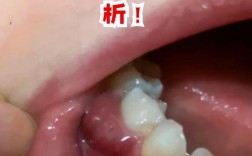 牙根尖脓肿的治疗方法