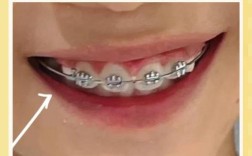 儿童兜齿矫正方法有哪些？家长该如何选择？