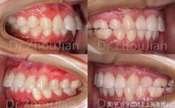 成人矫正牙齿后牙齿只剩24颗，是正常现象吗？