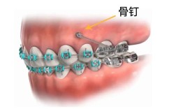 上颌骨打钉正畸