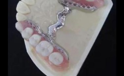 种牙镶牙活动牙