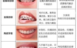 牙套有哪一种