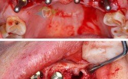 牙骨正畸手术后遗症可能引发哪些长期健康影响？