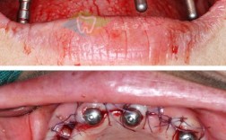 下颚骨拔一颗牙正畸