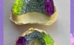 牙板固定之后正畸