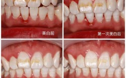 氟斑牙可以正畸嘛