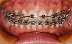 牙齿矫正器矫正效果如何？需注意哪些问题？