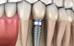 牙周正畸种植，治疗顺序如何定？