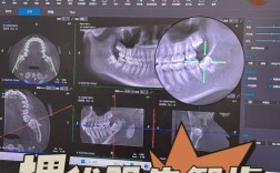牙齿矫正要拔智齿吗