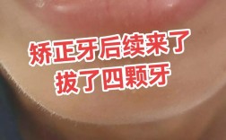 牙齿矫正拔牙，一般会拔哪些颗牙齿呢？