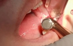 视频微创拨牙方法究竟是什么？它与传统拨牙相比有哪些独特优势，又适合哪些口腔问题呢？